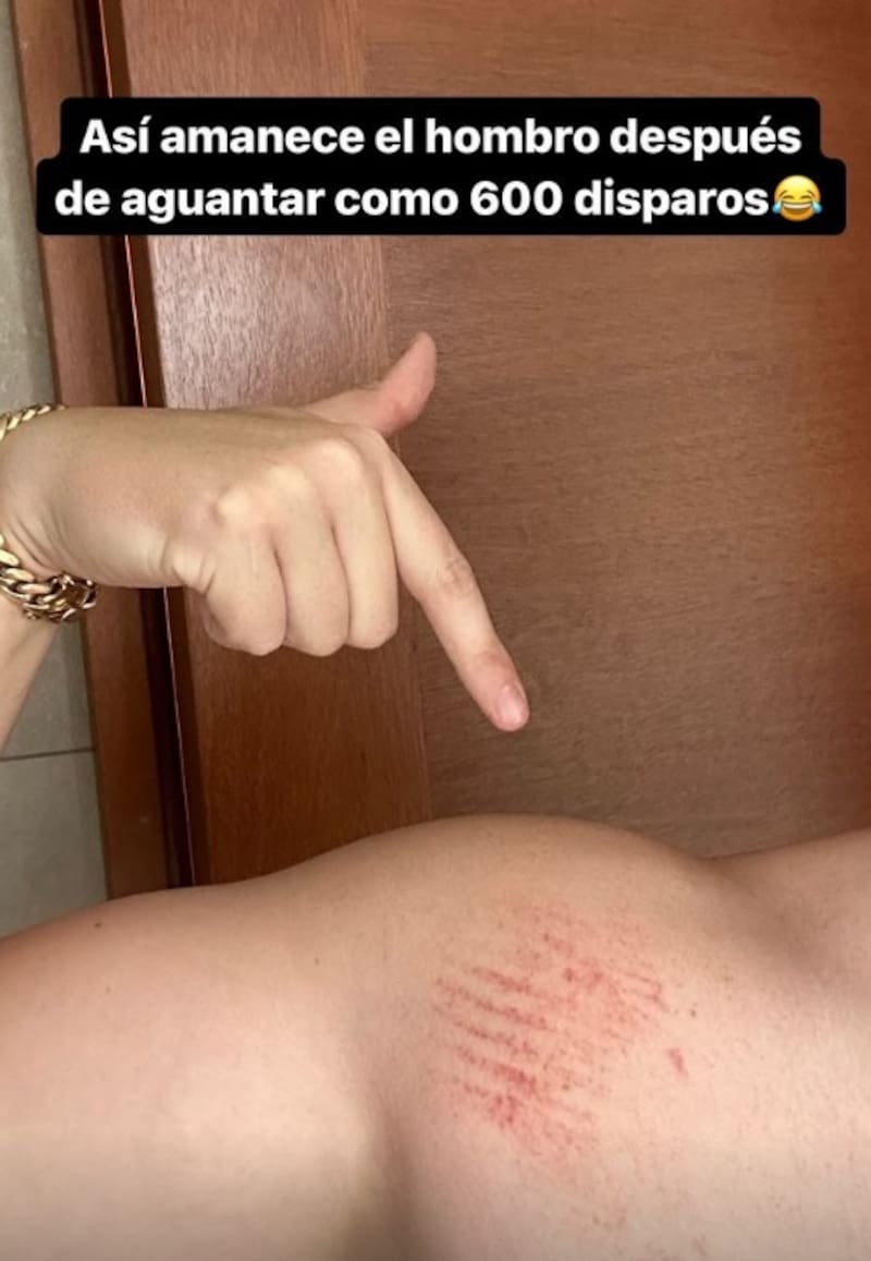 Nano Calderón mostró las secuelas tras manejas armas de guerra. Créditos: Instagram