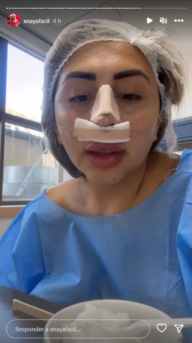 Naya Fácil documentó a través de sus historias de Instagram su nueva intervención estética, esta vez en la nariz, la cual salió una considerable suma de dinero.