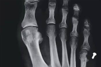 Clínica en Providencia deberá pagar $26 millones a paciente: le dejaron un tornillo dentro del pie