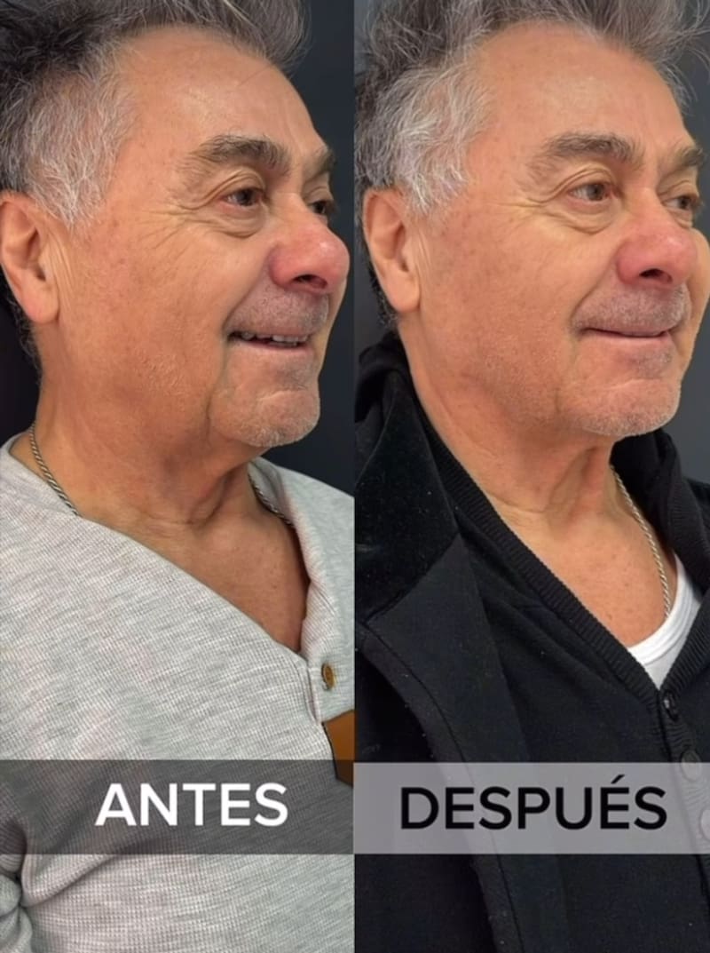 Pato Torres tras su intervención con hilos tensores. Créditos: Instagram