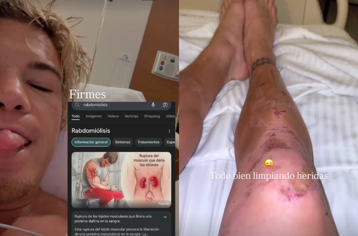 Rabdomiólisis: ¿En qué consiste la condición por la que fue hospitalizado Raimundo Cerda?