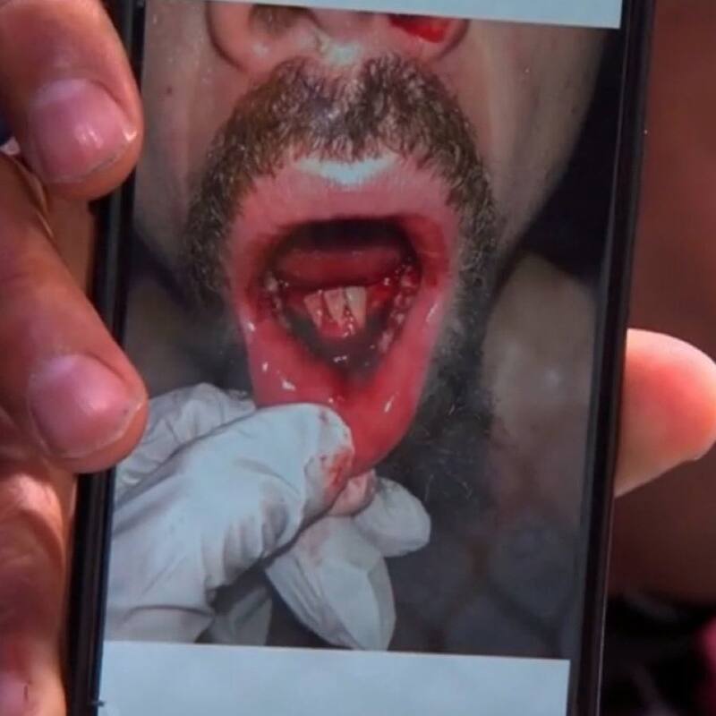 Robert Whittaker mostró su mandíbula.