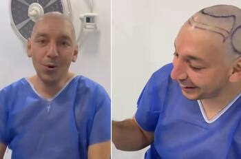 “Estoy contento y feliz”: Rodrigo Gallina se sometió a un cirugía de injerto capilar