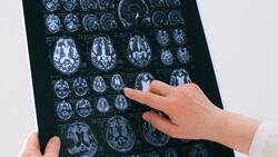 Alzheimer en aumento: La epidemia silenciosa del siglo XXI