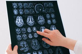 Alzheimer en aumento: La epidemia silenciosa del siglo XXI