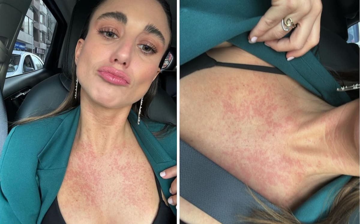 Tita Ureta mostró sus manchas en la piel. Créditos: Instagram