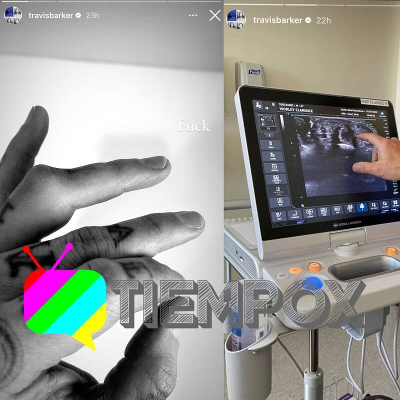 Mostró su lesión en la mano / Instagram