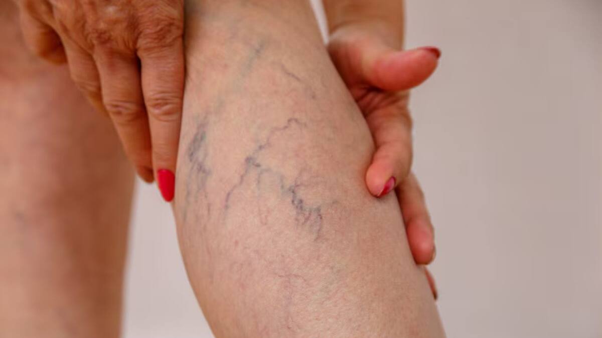 Esta es la infusión que te ayudará a prevenir la aparición de várices