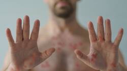 Confirman primer caso de la variante más peligrosa de la Viruela del Mono fuera de África