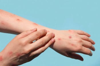 Detectan caso de viruela del mono en Chile: Estos son los síntomas de la enfermedad