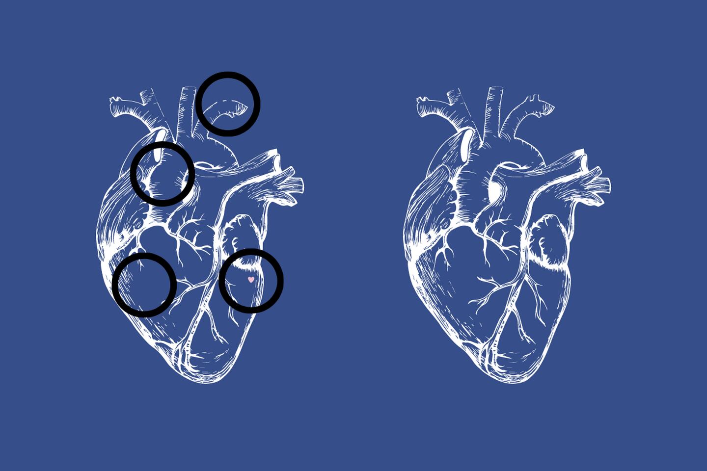 dos corazones blancos, con 4 diferencias entre ellos, las que están señaladas por círculos negros.